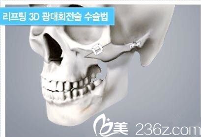 顴骨整形方式