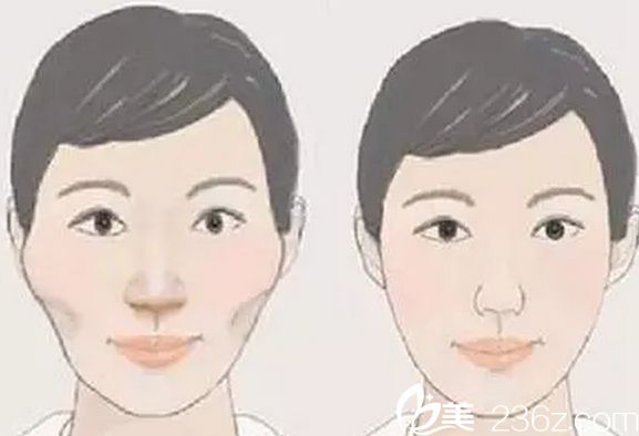 做顴骨整形哪家醫(yī)院好？北京做顴骨整形好的醫(yī)院