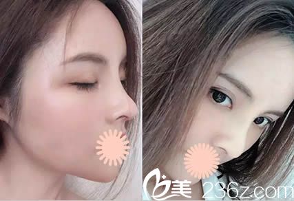 韓國(guó)清潭整形醫(yī)院怎么樣？奉上李丙玟院長(zhǎng)鼻部整形和全臉脂肪填充真實(shí)案例