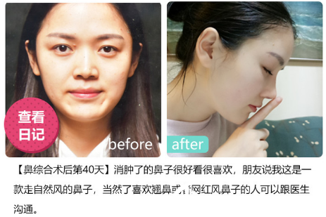 深圳美萊醫(yī)院周年慶優(yōu)惠整形價格表 雙眼皮6300元,隆鼻子8800元,隆胸16800元