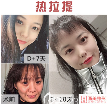七夕驚喜！西安畫(huà)美整形醫(yī)院低價(jià)整形價(jià)格公布，小鼻綜合套餐只需要4800元起