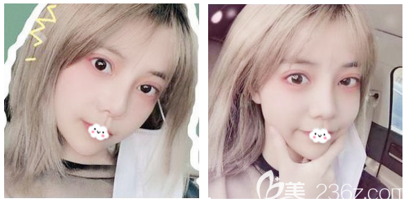 做完埋線雙眼皮修復兩個月了就問你們美不美？我自己感覺修復得很成功哦