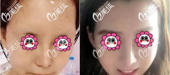 快來看看西安高一生要價(jià)10000多的面部自體脂肪填充案例再決定吧